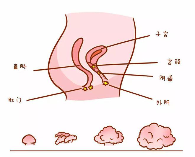 尖锐湿疣1